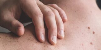 Realizarán una jornada de revisión de lunares y detección temprana de posibles lesiones en la piel