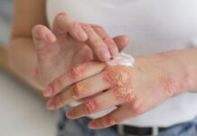 Aumentaron un 64% los casos de sífilis en el país, en comparación con la media del período 2020 – 2024