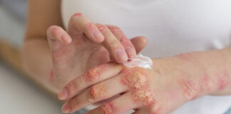 Aumentaron un 64% los casos de sífilis en el país, en comparación con la media del período 2020 – 2024